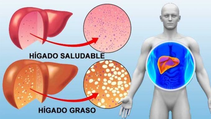 higado-graso caracteristicas